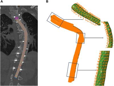 Biomechanical analysis of spinal cord injury during scoliosis correction surgery